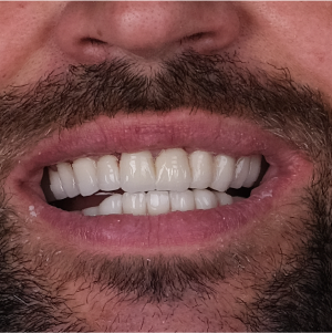 E-diş esenler,     Diş Tedavisi,Diş Estetiği,Diş Beyazlatma,     Ağız ve Diş Sağlığı,     Diş İmplantı,     Porselen Lamina,     Diş Protezi,     Çocuk Diş Hekimi,     Diş Ağrısı Tedavisi,     Gülüş Tasarımı,     Diş Temizliği,     Periodontal Tedavi,     Diş Eti Hastalıkları,     Diş Fırçalama Teknikleri,     Köprü Protez Tedavisi,     Kanal Tedavisi,     Diş Hekimi Randevusu,     Diş Beyazlatma Fiyatları,     Ağız Kokusu Nedenleri,     Diş Çürümesi Tedavisi,     Diş Hekimi İstanbul,     Diş Hekimi Danışmanlığı,     Ağız Hijyeni Önerileri