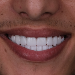 E-diş esenler,     Diş Tedavisi,Diş Estetiği,Diş Beyazlatma,     Ağız ve Diş Sağlığı,     Diş İmplantı,     Porselen Lamina,     Diş Protezi,     Çocuk Diş Hekimi,     Diş Ağrısı Tedavisi,     Gülüş Tasarımı,     Diş Temizliği,     Periodontal Tedavi,     Diş Eti Hastalıkları,     Diş Fırçalama Teknikleri,     Köprü Protez Tedavisi,     Kanal Tedavisi,     Diş Hekimi Randevusu,     Diş Beyazlatma Fiyatları,     Ağız Kokusu Nedenleri,     Diş Çürümesi Tedavisi,     Diş Hekimi İstanbul,     Diş Hekimi Danışmanlığı,     Ağız Hijyeni Önerileri