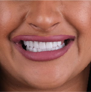 E-diş esenler,     Diş Tedavisi,Diş Estetiği,Diş Beyazlatma,     Ağız ve Diş Sağlığı,     Diş İmplantı,     Porselen Lamina,     Diş Protezi,     Çocuk Diş Hekimi,     Diş Ağrısı Tedavisi,     Gülüş Tasarımı,     Diş Temizliği,     Periodontal Tedavi,     Diş Eti Hastalıkları,     Diş Fırçalama Teknikleri,     Köprü Protez Tedavisi,     Kanal Tedavisi,     Diş Hekimi Randevusu,     Diş Beyazlatma Fiyatları,     Ağız Kokusu Nedenleri,     Diş Çürümesi Tedavisi,     Diş Hekimi İstanbul,     Diş Hekimi Danışmanlığı,     Ağız Hijyeni Önerileri