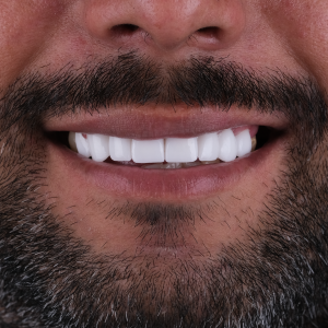 E-diş esenler,     Diş Tedavisi,Diş Estetiği,Diş Beyazlatma,     Ağız ve Diş Sağlığı,     Diş İmplantı,     Porselen Lamina,     Diş Protezi,     Çocuk Diş Hekimi,     Diş Ağrısı Tedavisi,     Gülüş Tasarımı,     Diş Temizliği,     Periodontal Tedavi,     Diş Eti Hastalıkları,     Diş Fırçalama Teknikleri,     Köprü Protez Tedavisi,     Kanal Tedavisi,     Diş Hekimi Randevusu,     Diş Beyazlatma Fiyatları,     Ağız Kokusu Nedenleri,     Diş Çürümesi Tedavisi,     Diş Hekimi İstanbul,     Diş Hekimi Danışmanlığı,     Ağız Hijyeni Önerileri