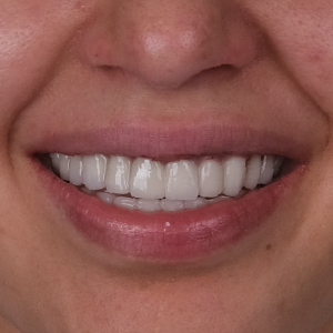 E-diş esenler,     Diş Tedavisi,Diş Estetiği,Diş Beyazlatma,     Ağız ve Diş Sağlığı,     Diş İmplantı,     Porselen Lamina,     Diş Protezi,     Çocuk Diş Hekimi,     Diş Ağrısı Tedavisi,     Gülüş Tasarımı,     Diş Temizliği,     Periodontal Tedavi,     Diş Eti Hastalıkları,     Diş Fırçalama Teknikleri,     Köprü Protez Tedavisi,     Kanal Tedavisi,     Diş Hekimi Randevusu,     Diş Beyazlatma Fiyatları,     Ağız Kokusu Nedenleri,     Diş Çürümesi Tedavisi,     Diş Hekimi İstanbul,     Diş Hekimi Danışmanlığı,     Ağız Hijyeni Önerileri