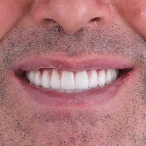 E-diş esenler,     Diş Tedavisi,Diş Estetiği,Diş Beyazlatma,     Ağız ve Diş Sağlığı,     Diş İmplantı,     Porselen Lamina,     Diş Protezi,     Çocuk Diş Hekimi,     Diş Ağrısı Tedavisi,     Gülüş Tasarımı,     Diş Temizliği,     Periodontal Tedavi,     Diş Eti Hastalıkları,     Diş Fırçalama Teknikleri,     Köprü Protez Tedavisi,     Kanal Tedavisi,     Diş Hekimi Randevusu,     Diş Beyazlatma Fiyatları,     Ağız Kokusu Nedenleri,     Diş Çürümesi Tedavisi,     Diş Hekimi İstanbul,     Diş Hekimi Danışmanlığı,     Ağız Hijyeni Önerileri