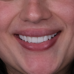 E-diş esenler,     Diş Tedavisi,Diş Estetiği,Diş Beyazlatma,     Ağız ve Diş Sağlığı,     Diş İmplantı,     Porselen Lamina,     Diş Protezi,     Çocuk Diş Hekimi,     Diş Ağrısı Tedavisi,     Gülüş Tasarımı,     Diş Temizliği,     Periodontal Tedavi,     Diş Eti Hastalıkları,     Diş Fırçalama Teknikleri,     Köprü Protez Tedavisi,     Kanal Tedavisi,     Diş Hekimi Randevusu,     Diş Beyazlatma Fiyatları,     Ağız Kokusu Nedenleri,     Diş Çürümesi Tedavisi,     Diş Hekimi İstanbul,     Diş Hekimi Danışmanlığı,     Ağız Hijyeni Önerileri