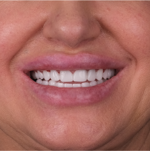 E-diş esenler,     Diş Tedavisi,Diş Estetiği,Diş Beyazlatma,     Ağız ve Diş Sağlığı,     Diş İmplantı,     Porselen Lamina,     Diş Protezi,     Çocuk Diş Hekimi,     Diş Ağrısı Tedavisi,     Gülüş Tasarımı,     Diş Temizliği,     Periodontal Tedavi,     Diş Eti Hastalıkları,     Diş Fırçalama Teknikleri,     Köprü Protez Tedavisi,     Kanal Tedavisi,     Diş Hekimi Randevusu,     Diş Beyazlatma Fiyatları,     Ağız Kokusu Nedenleri,     Diş Çürümesi Tedavisi,     Diş Hekimi İstanbul,     Diş Hekimi Danışmanlığı,     Ağız Hijyeni Önerileri